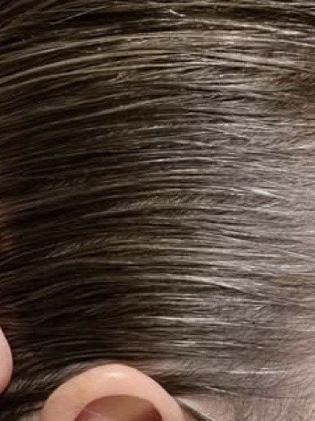 Hårserum case 10 — efter