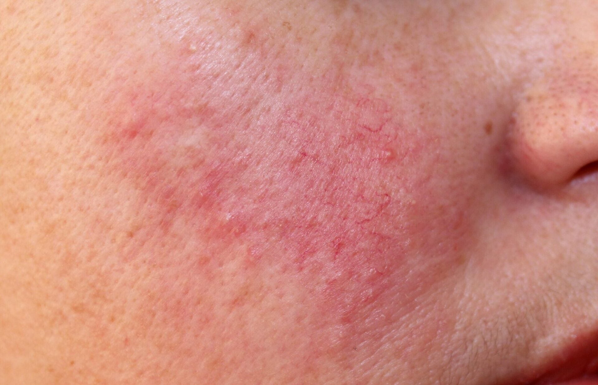 Din guide til naturlig rosacea behandling