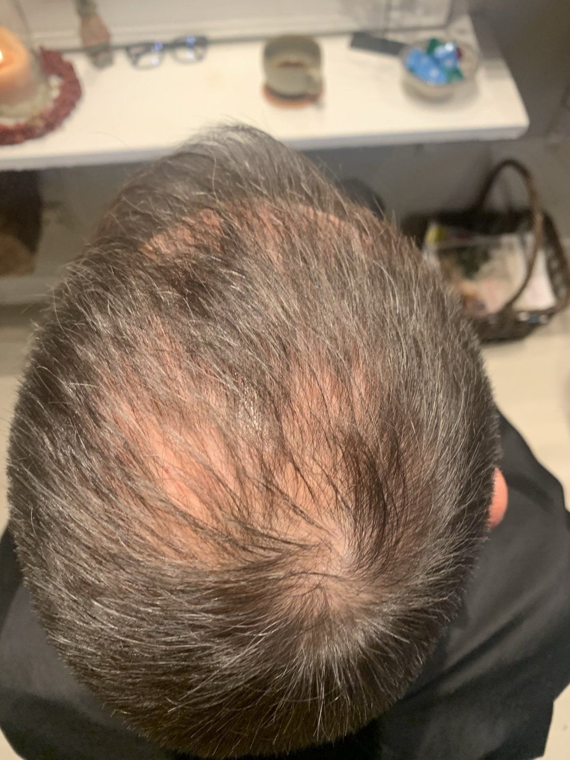 Hårserum case 1 — efter