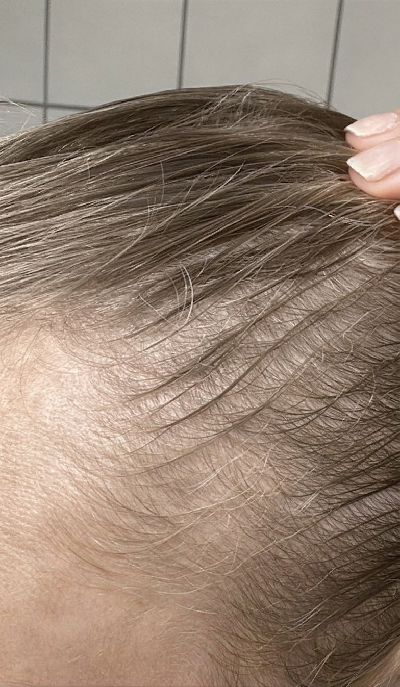 Hårserum case 3 — efter