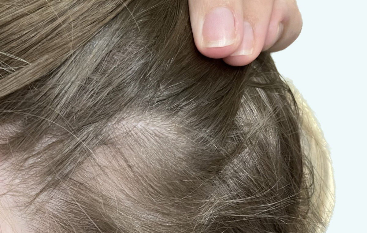 Hårserum case 4 — efter