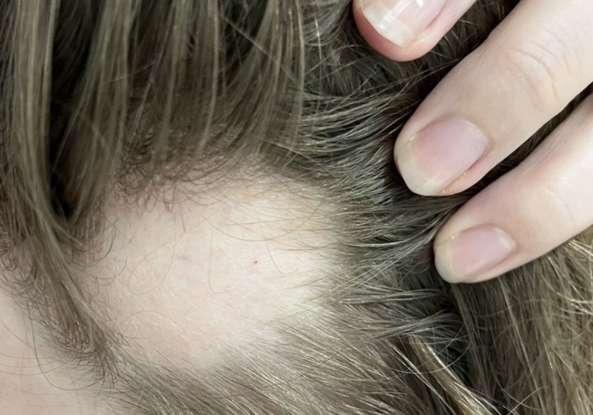 Hårserum case 4 — før