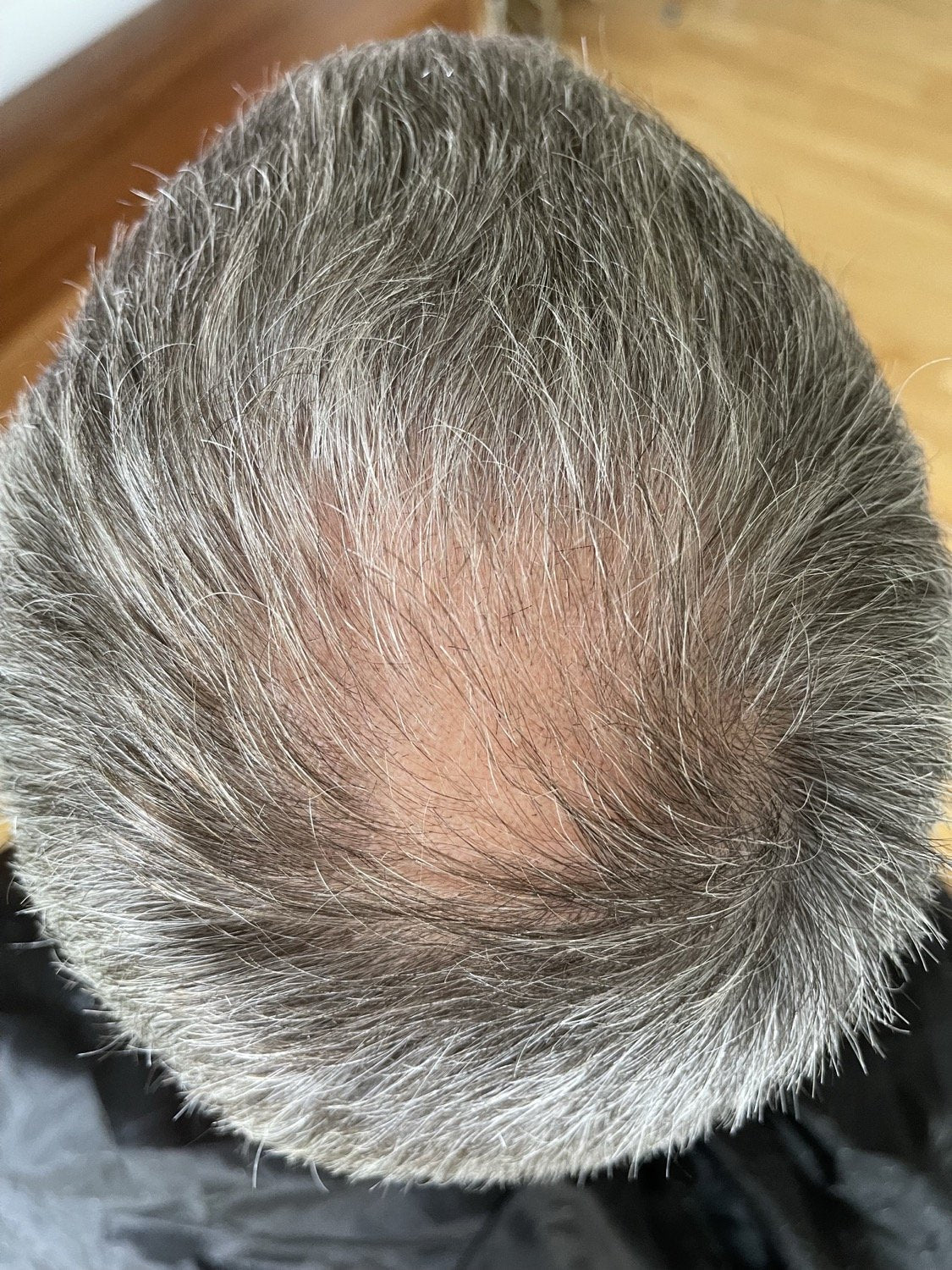 Hårserum case 6 — efter