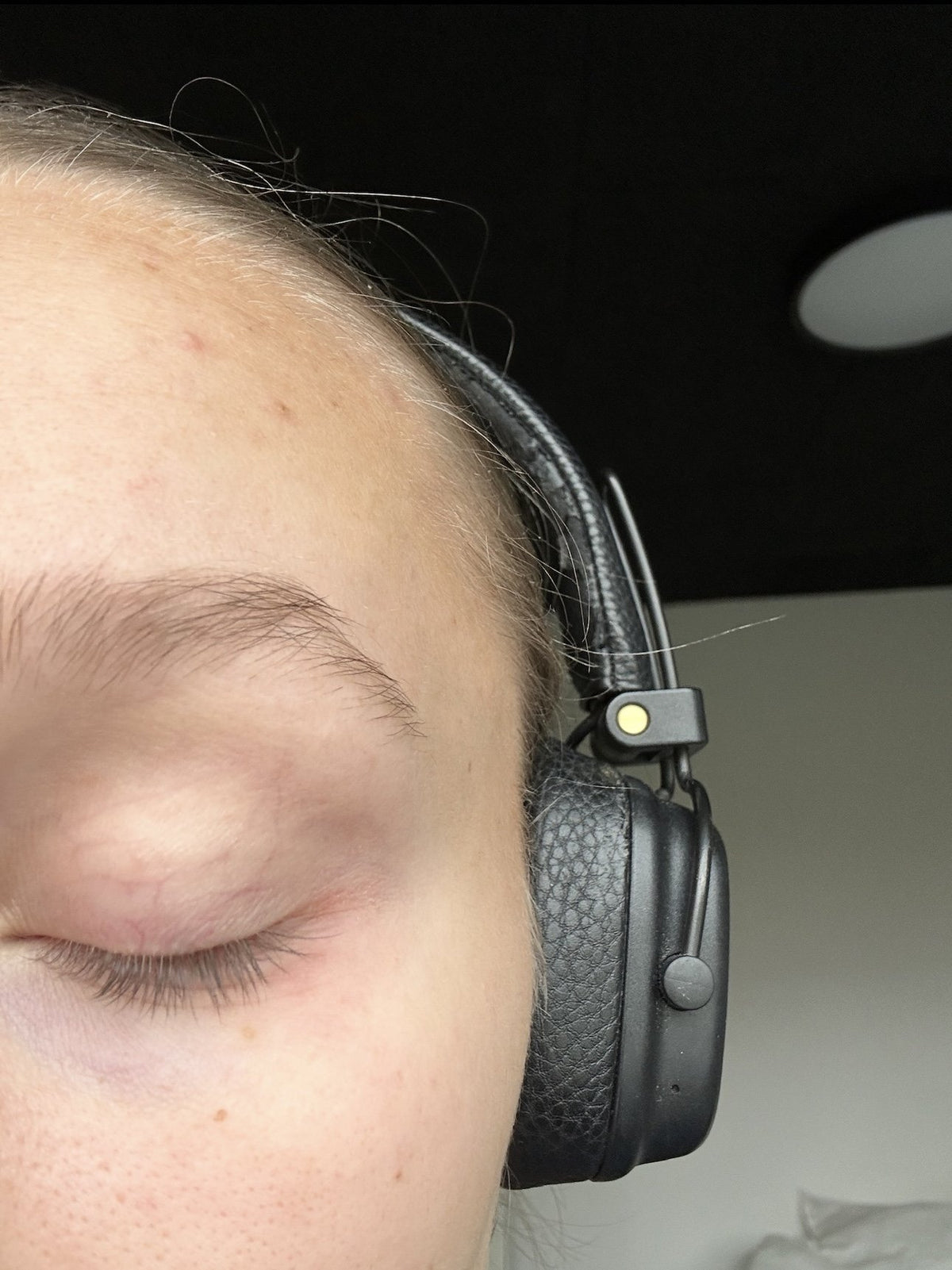 Vippeserum Nikoline N. — før