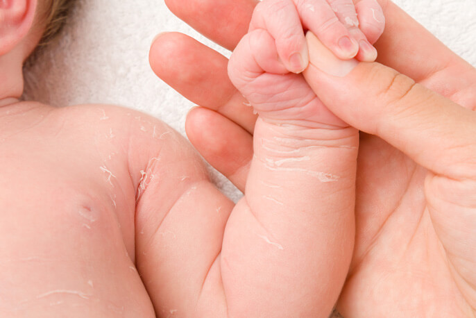 Har din baby tør hud? Tips til pleje af babyhud |