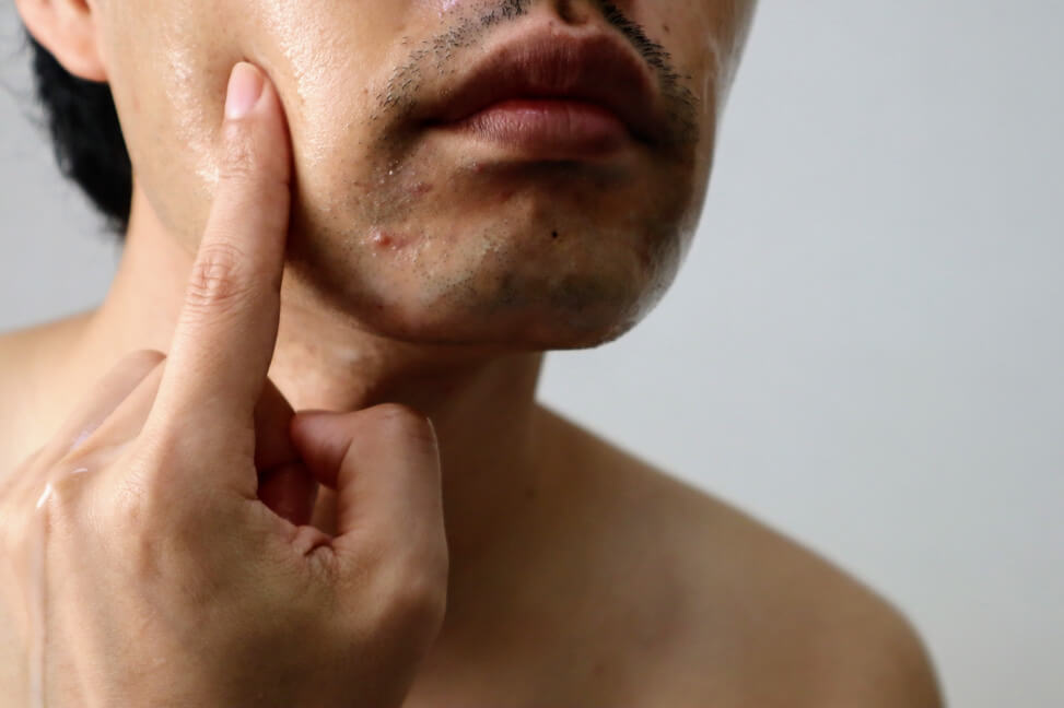 tør hud i ansigtet hos mænd
