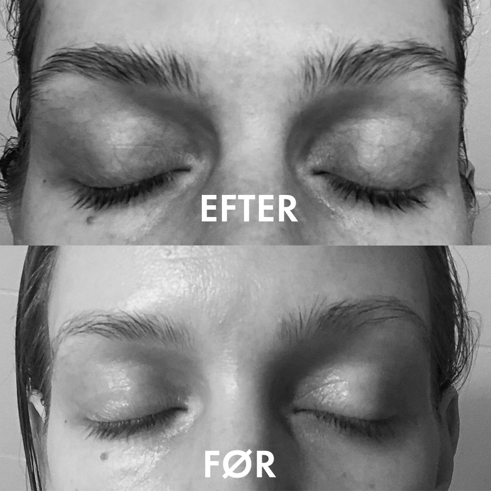 før efter vippeserum