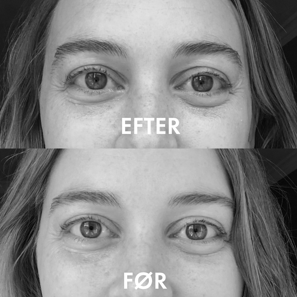 før efter vippeserum